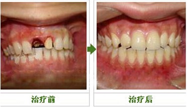 單顆牙缺失.jpg